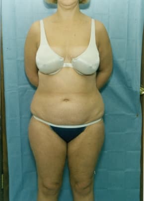Liposuction and VASERLipo Before & After Patient #1014