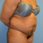 Liposuction and VASERLipo Before & After Patient #1012