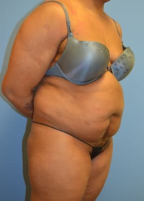 Liposuction and VASERLipo Before & After Patient #1012