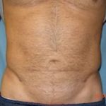Liposuction and VASERLipo Before & After Patient #1011