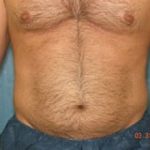 Liposuction and VASERLipo Before & After Patient #1011