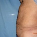 Liposuction and VASERLipo Before & After Patient #1010