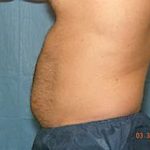 Liposuction and VASERLipo Before & After Patient #1010