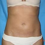 Liposuction and VASERLipo Before & After Patient #1009