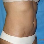 Liposuction and VASERLipo Before & After Patient #1008