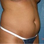 Liposuction and VASERLipo Before & After Patient #1008