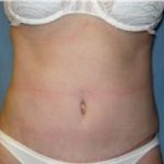 Liposuction and VASERLipo Before & After Patient #1007