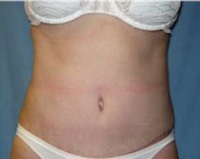 Liposuction and VASERLipo Before & After Patient #1007