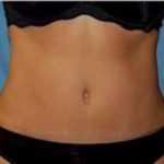 Liposuction and VASERLipo Before & After Patient #1007