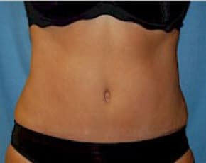 Liposuction and VASERLipo Before & After Patient #1007