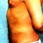 Liposuction and VASERLipo Before & After Patient #1006