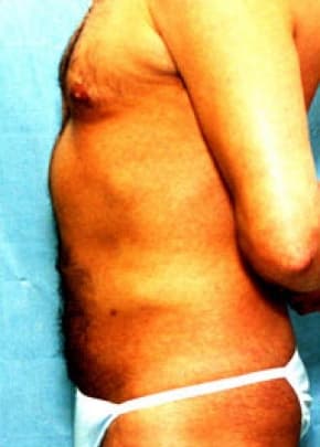 Liposuction and VASERLipo Before & After Patient #1006