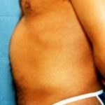 Liposuction and VASERLipo Before & After Patient #1006