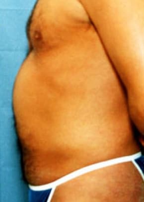 Liposuction and VASERLipo Before & After Patient #1006