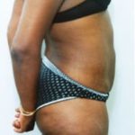 Liposuction and VASERLipo Before & After Patient #1005