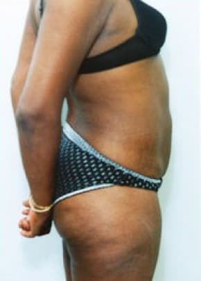 Liposuction and VASERLipo Before & After Patient #1005