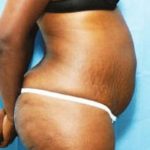 Liposuction and VASERLipo Before & After Patient #1005