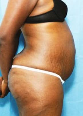Liposuction and VASERLipo Before & After Patient #1005