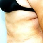 Liposuction and VASERLipo Before & After Patient #1004