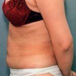 Liposuction and VASERLipo Before & After Patient #1003