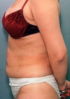 Liposuction and VASERLipo Before & After Patient #1003