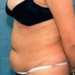 Liposuction and VASERLipo Before & After Patient #1003