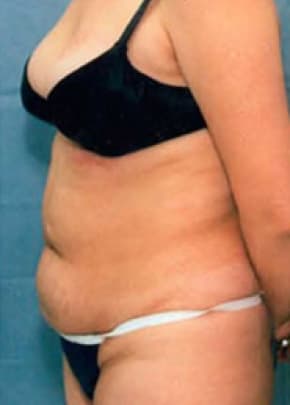 Liposuction and VASERLipo Before & After Patient #1003