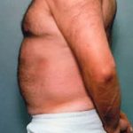 Liposuction and VASERLipo Before & After Patient #1002