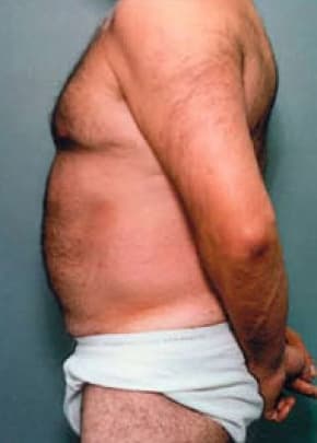 Liposuction and VASERLipo Before & After Patient #1002