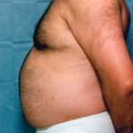 Liposuction and VASERLipo Before & After Patient #1002