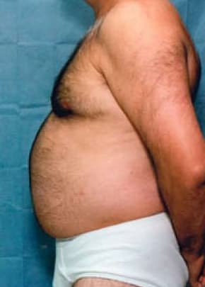 Liposuction and VASERLipo Before & After Patient #1002
