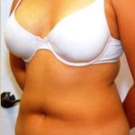 Liposuction and VASERLipo Before & After Patient #1001