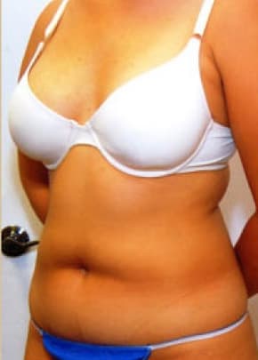 Liposuction and VASERLipo Before & After Patient #1001