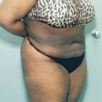 Liposuction and VASERLipo Before & After Patient #1000
