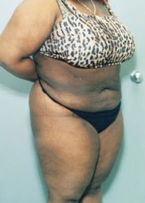 Liposuction and VASERLipo Before & After Patient #1000