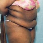 Liposuction and VASERLipo Before & After Patient #1000
