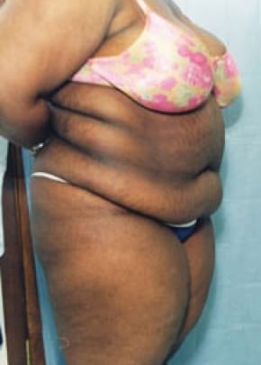 Liposuction and VASERLipo Before & After Patient #1000