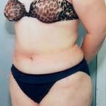 Liposuction and VASERLipo Before & After Patient #999
