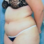 Liposuction and VASERLipo Before & After Patient #999
