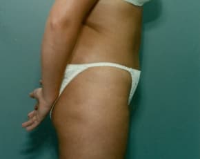 Liposuction and VASERLipo Before & After Patient #998