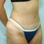 Liposuction and VASERLipo Before & After Patient #997