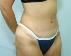 Liposuction and VASERLipo Before & After Patient #997
