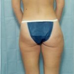 Liposuction and VASERLipo Before & After Patient #996