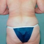 Liposuction and VASERLipo Before & After Patient #995