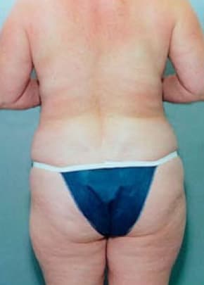 Liposuction and VASERLipo Before & After Patient #995