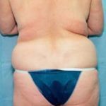 Liposuction and VASERLipo Before & After Patient #995