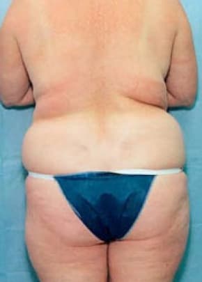 Liposuction and VASERLipo Before & After Patient #995