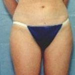Liposuction and VASERLipo Before & After Patient #994