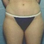 Liposuction and VASERLipo Before & After Patient #994