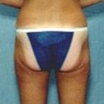 Liposuction and VASERLipo Before & After Patient #993